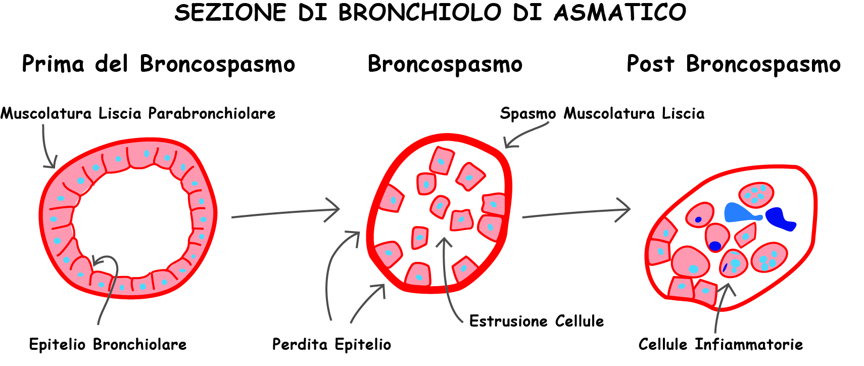 Sezione di Bronchiolo di Asmatico